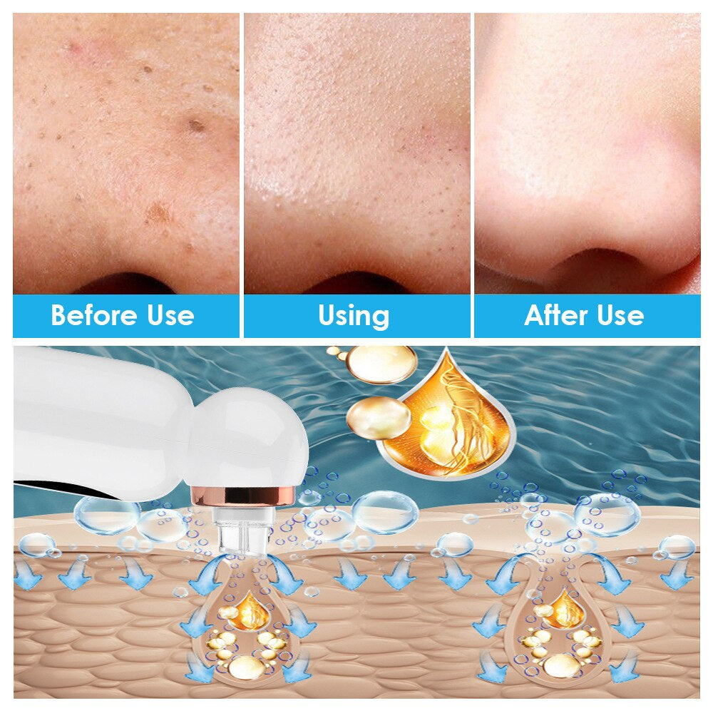 | Hydrodermabrasion Mitesserentferner