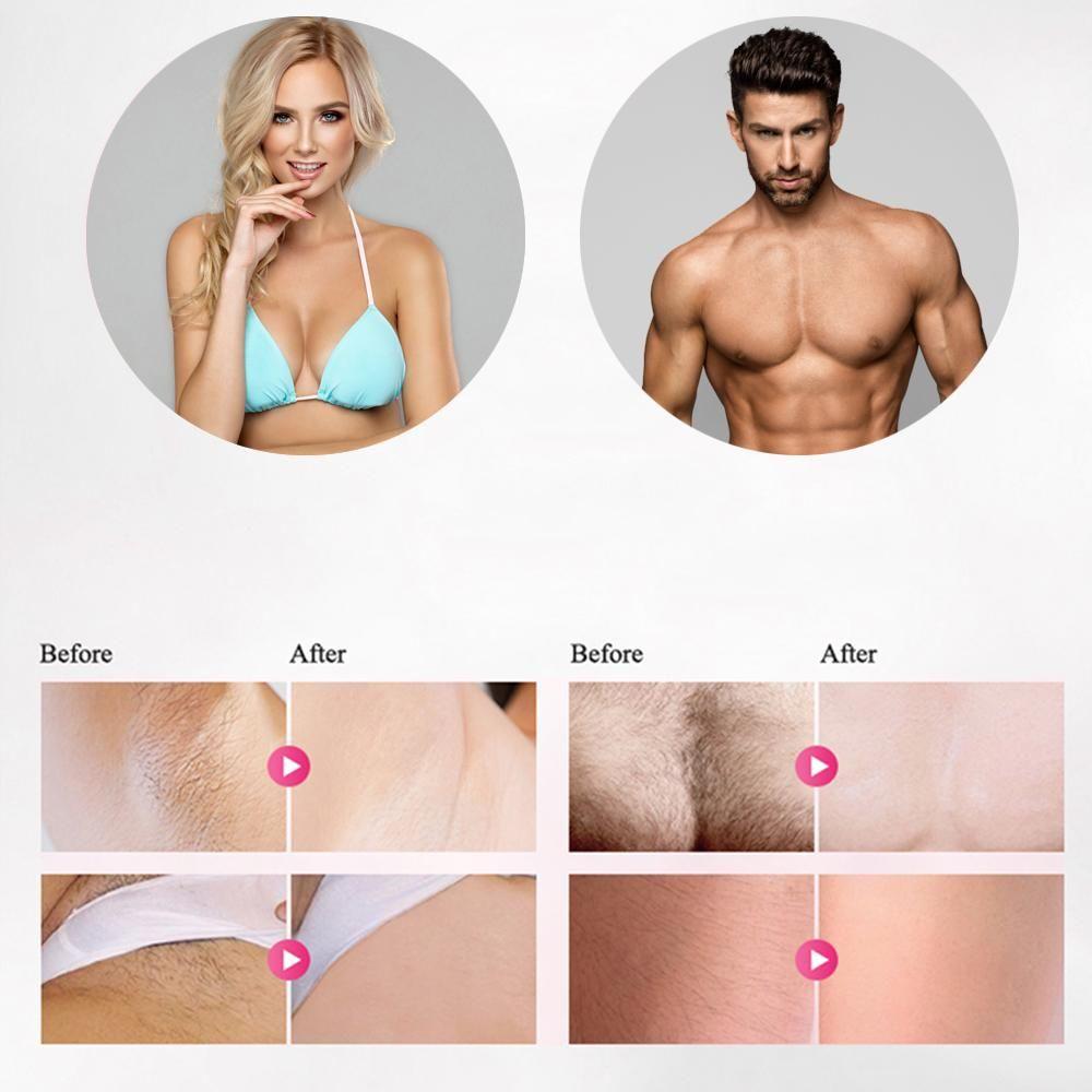 | Professioneller IPL Epilierer Laser-Haarentfernung