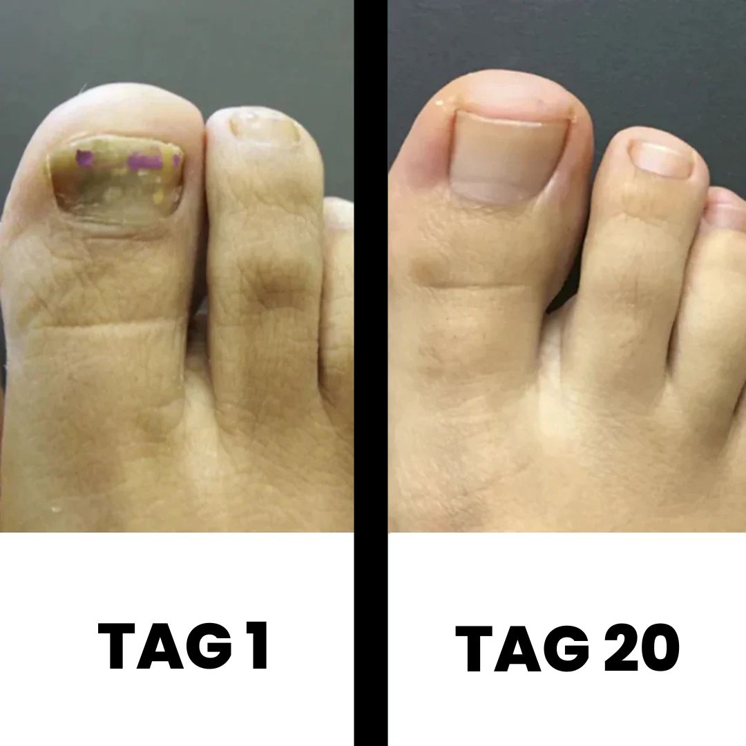 PureNail - patentierte Nagelpilz-Therapie - für gesunde Nägel innerhalb von 4 Wochen